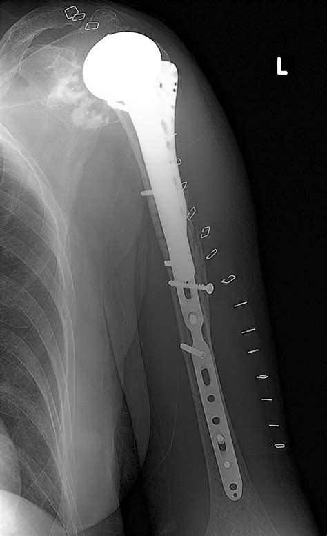 metal bracket in femur bone|Open Reduction & Internal Fixation (ORIF): What It Is .